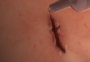 This surgical glue seals wounds without staples or stitches.