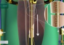 Tibia bone transport over an intramedullar nail