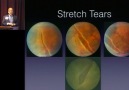 Traumatic Retinal Visual Loss Sunir J. Garg MD