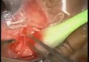 Unbelievable Live worm removed from patient eye
