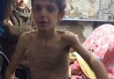 UNICEF Confirms Madaya Starvation