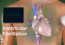 Ventricular Fibrilasyona Girmiş Kalbin Animasyonu...