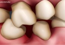 What Happens After a Tooth Extraction?