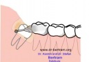 Wisdom Tooth Extraction 3D animation