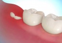 Wisdom Tooth Removal