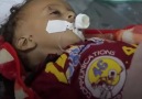 Yemen'de Çocuklar Açlıktan Ölüyor