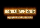 You can listen AVF bruit...