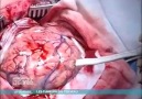 Beyin Tümörü Ameliyatı