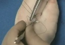 devamlı sutur atma tekniği---vakaloji