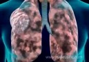 Emphysema