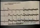 12 Lead ECG Placement Part I- [ 112 ACiL ]