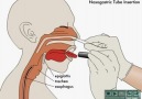 Nazogastrik sonda uygulama video 2---NAZAN